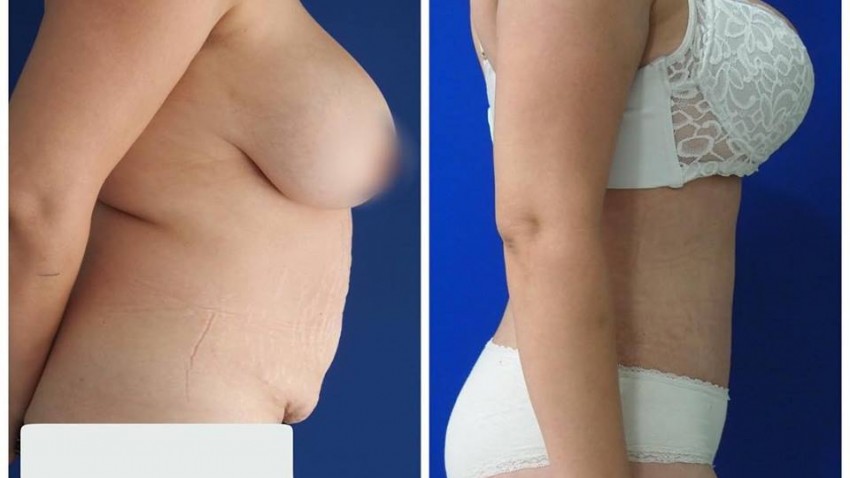 foto principal de Lipoabdominoplastia