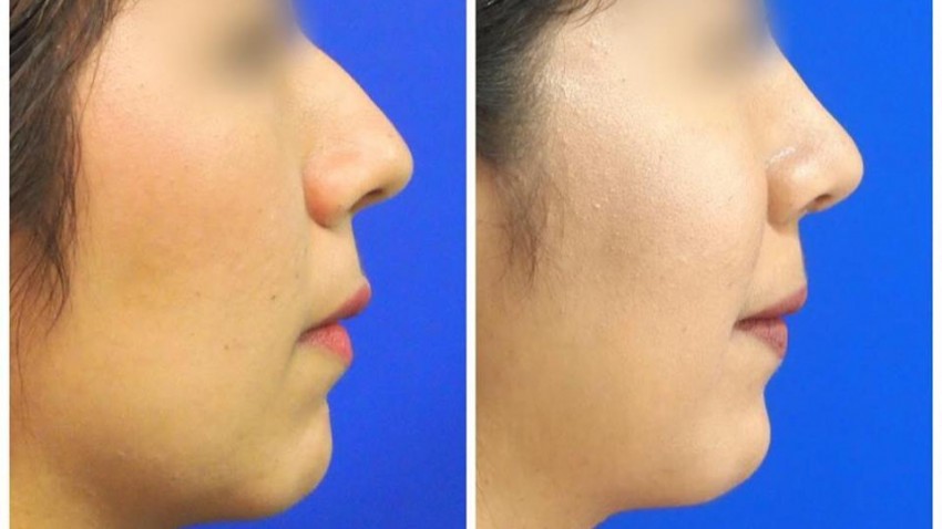 foto principal de Rinoplastia