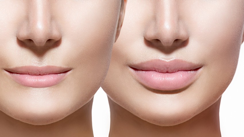 Aumento de labios imagen