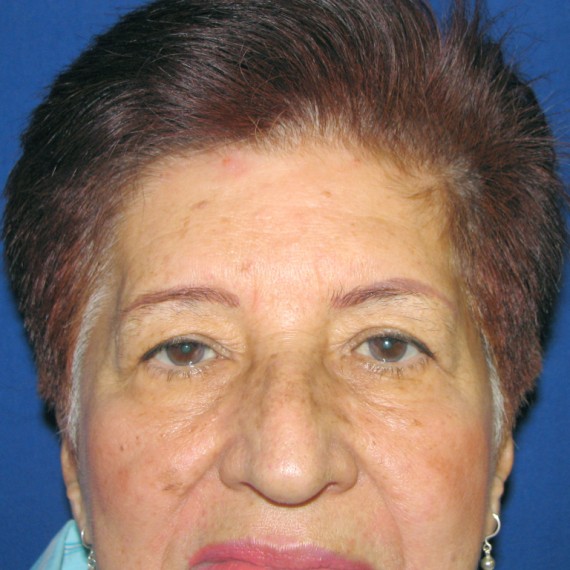 imagen antes Blefaroplastia