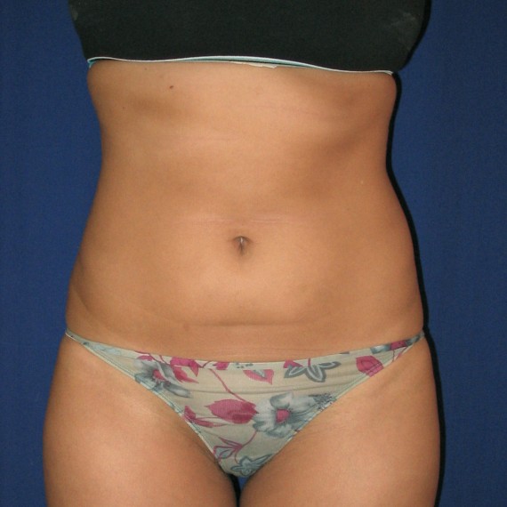 imagen antes Lipoaspiración