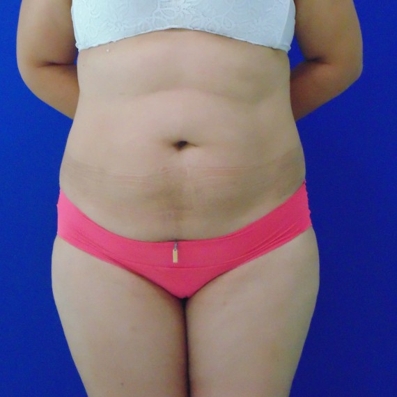 imagen antes Lipoabdominoplastia