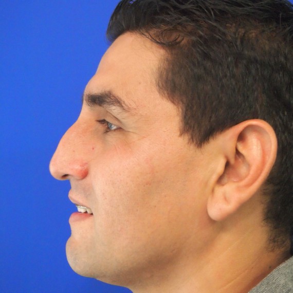 imagen antes Rinoplastia