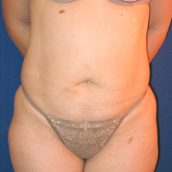 imagen antes Abdomen