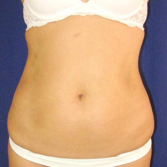 imagen antes Abdomen