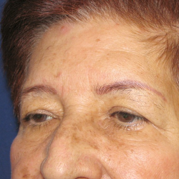 imagen antes Blefaroplastia