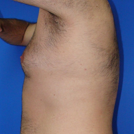 imagen antes Ginecomastia