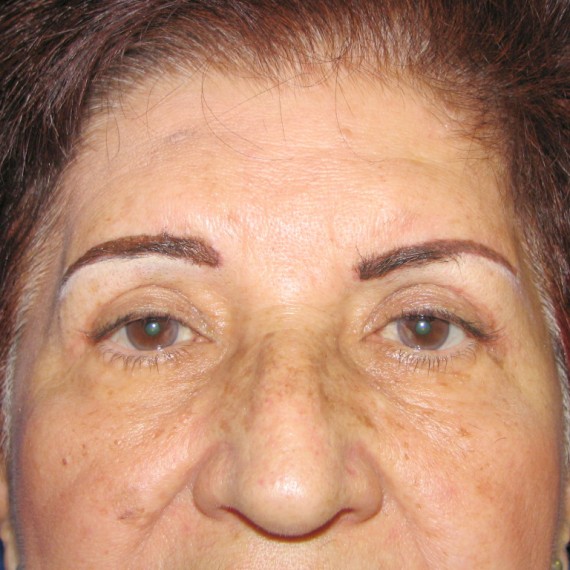 imagen despues Blefaroplastia