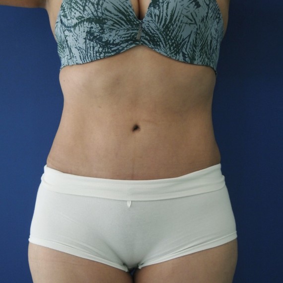 imagen despues Lipoabdominoplastia