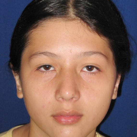 imagen despues Otoplastia