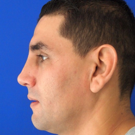imagen despues Rinoplastia