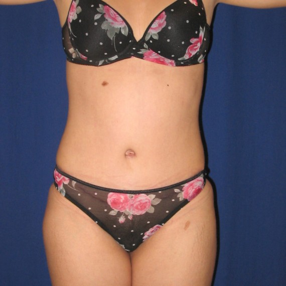 imagen despues Abdomen