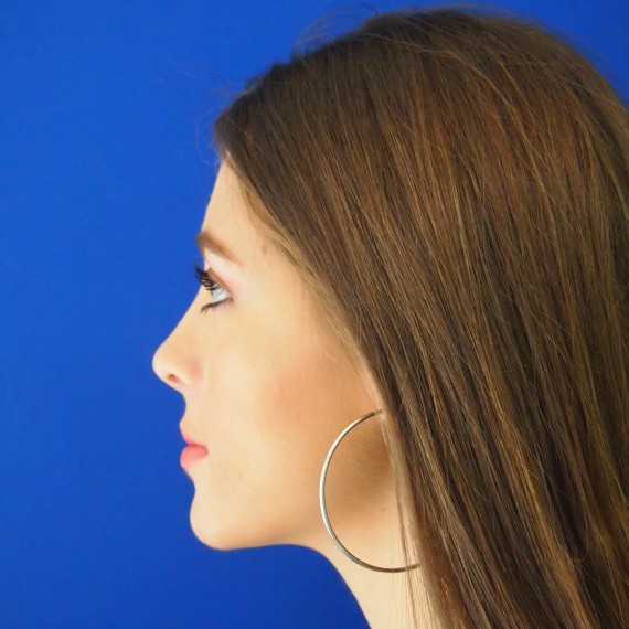 imagen despues Rinoplastia