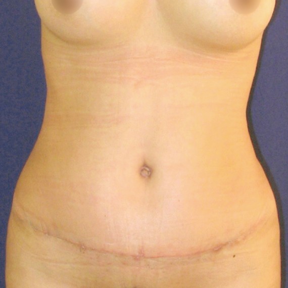 imagen despues Abdomen
