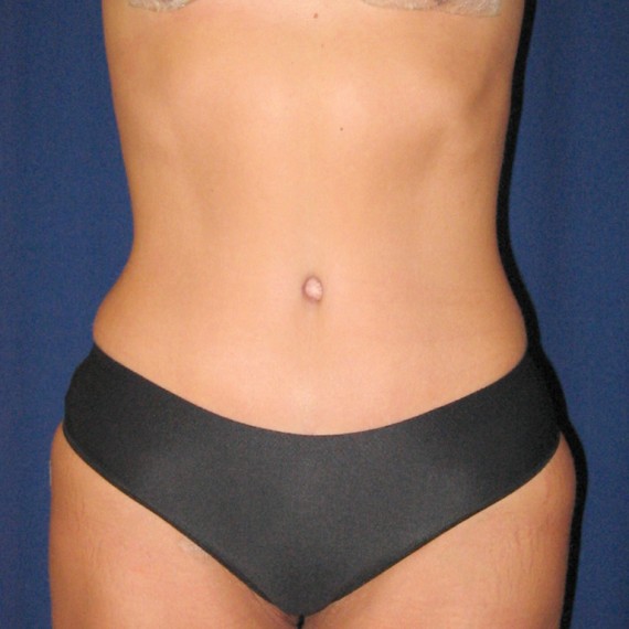 imagen despues Abdomen