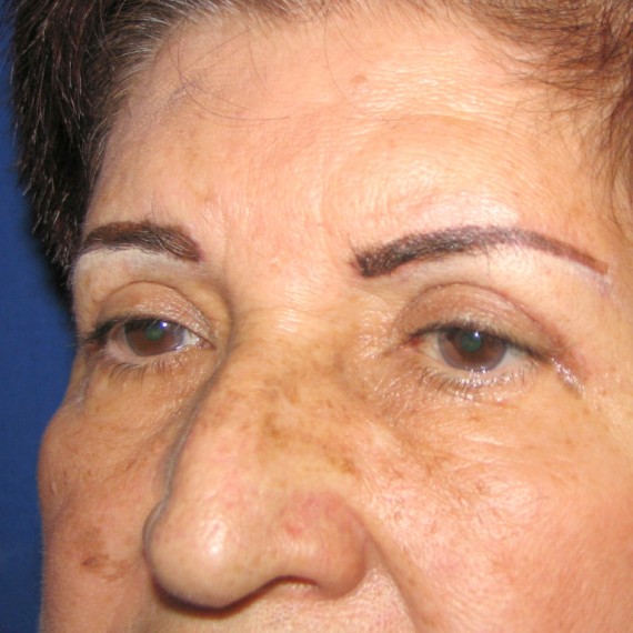 imagen despues Blefaroplastia