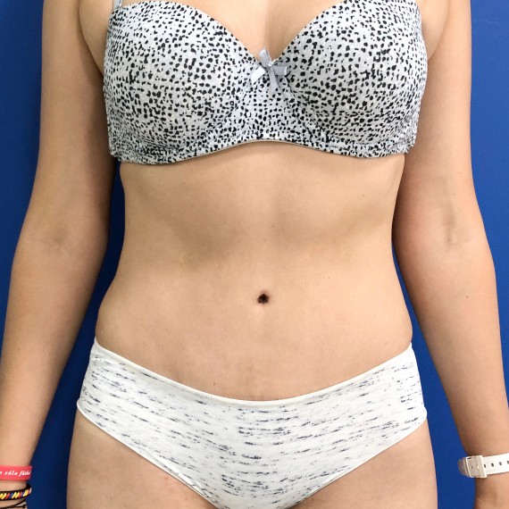 imagen despues Lipoabdominoplastia