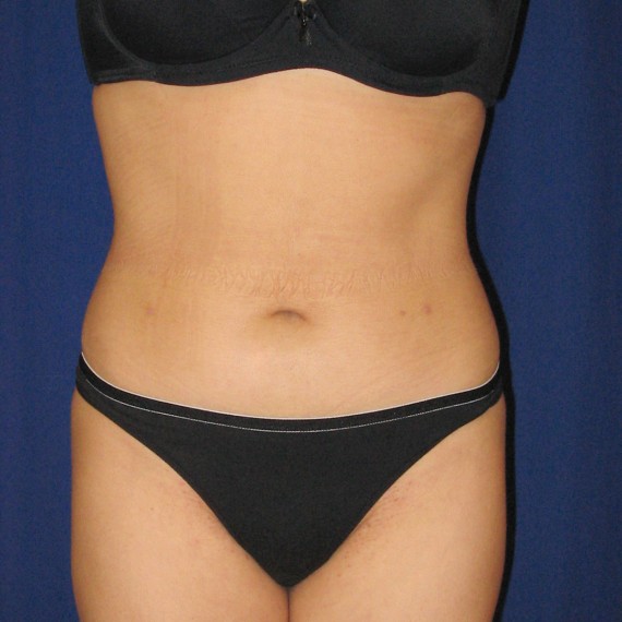 imagen despues Lipoaspiración