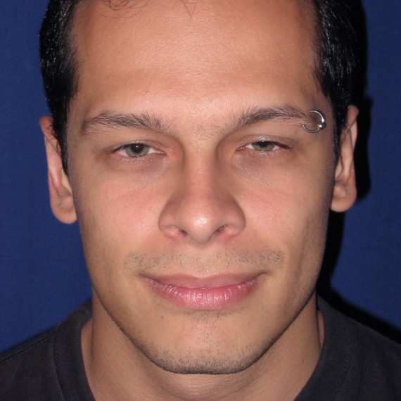 imagen despues Otoplastia
