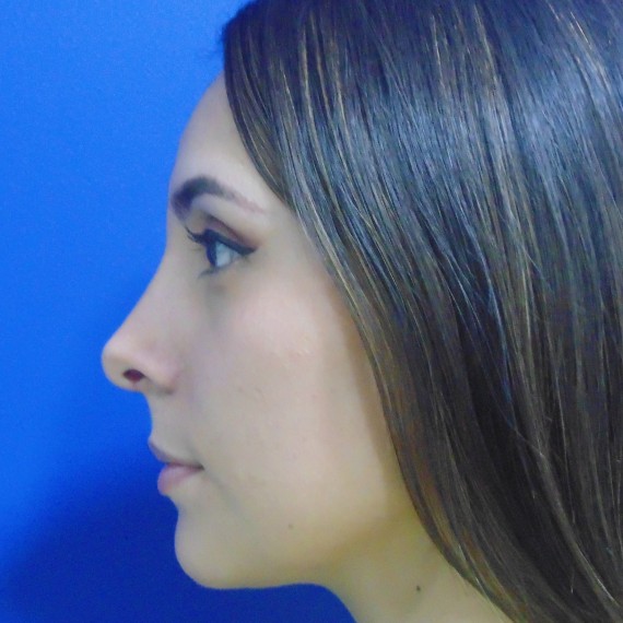 imagen despues Rinoplastia