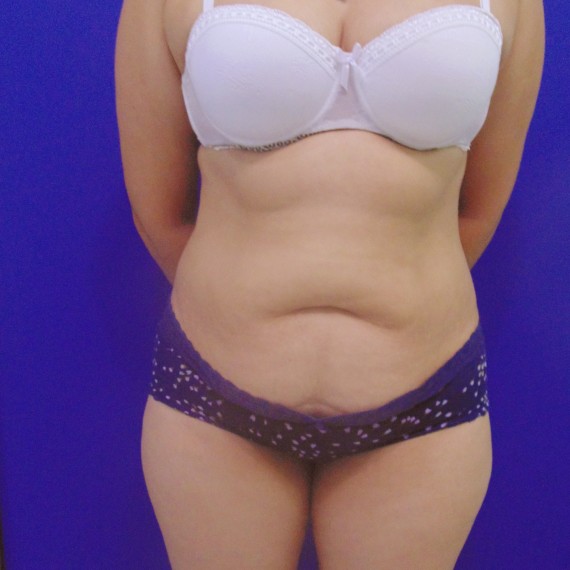 imagen antes Lipoabdominoplastia