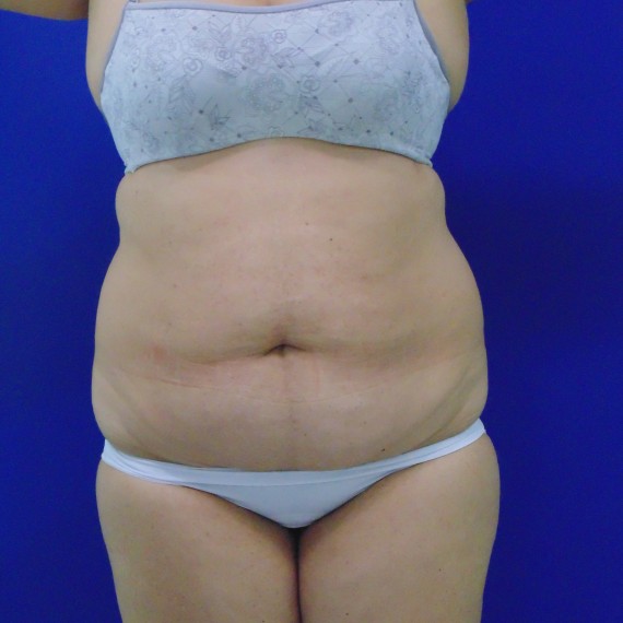 imagen antes Lipoabdominoplastia