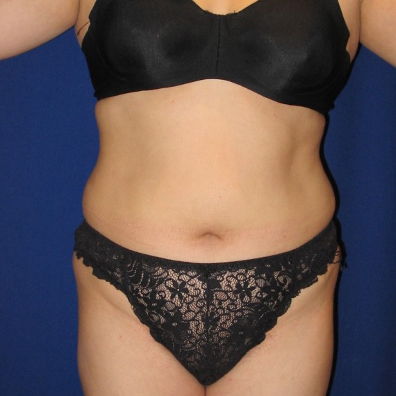 imagen antes Lipoaspiración