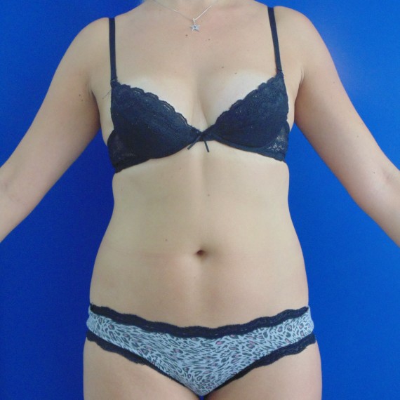 imagen antes Lipoescultura