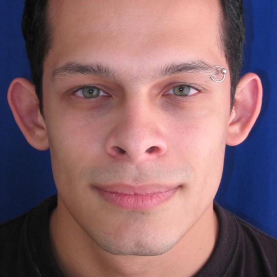 imagen antes Otoplastia